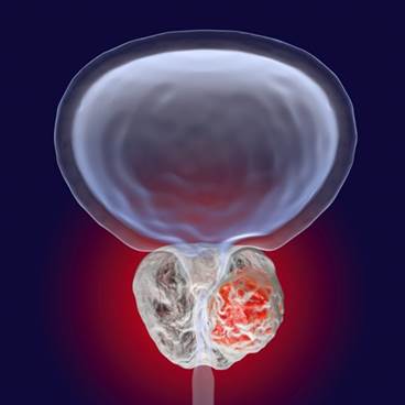 Barriers to Prostate Cancer Research in Black Men Identified Barriers to Prostate Cancer Research in Black Men Identified