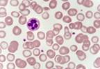 No Reduction in Platelets Found With IV Iron Use in CKD No Reduction in Platelets Found With IV Iron Use in CKD
