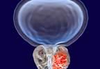 Nocturia in BPH Patients Safely Treated with Silodosin Nocturia in BPH Patients Safely Treated with Silodosin