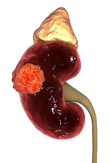The likelihood of aggressive kidney tumor histology increased along with tumor size, a new study found. The likelihood of aggressive kidney tumor histology increased along with tumor size, a new study found.