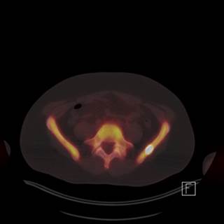Novel imaging and tumor biomarker assays are likely to define non-metastatic castration-resistant prostate cancer more accurately, authors of new review state. Novel imaging and tumor biomarker assays are likely to define non-metastatic castration-resistant prostate cancer more accurately, authors of new review state.