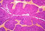 Diabetes Population Has Higher Incidences of Bladder, Kidney Cancer Diabetes Population Has Higher Incidences of Bladder, Kidney Cancer
