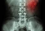 Kidney Stones Linked to Hyponatremia Kidney Stones Linked to Hyponatremia