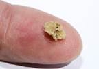 Ureteral Wall Thickness Predicts Stone Passage Ureteral Wall Thickness Predicts Stone Passage