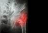Prostate Cancer ADT Ups Osteoporotic Fracture Risk Prostate Cancer ADT Ups Osteoporotic Fracture Risk