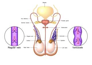 Hypogonadism and serum testosterone evaluation nearly doubled the odds a man would undergo varicocelectomy. Hypogonadism and serum testosterone evaluation nearly doubled the odds a man would undergo varicocelectomy.